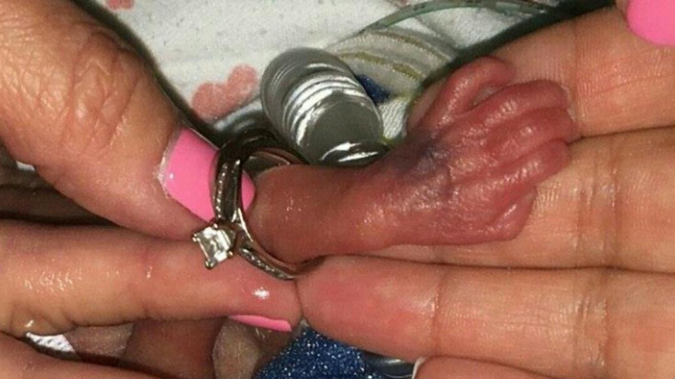 Prematura que pesó 368 gramos fue dada de alta tras cuatro meses