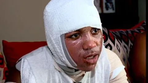 El peligroso reto viral “Hot Water Challenge” deja con graves quemaduras a un joven de 15 años