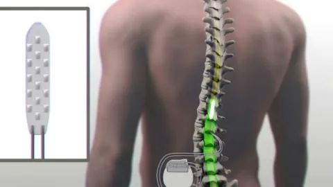 Gran avance para la ciencia: Parapléjico logra caminar con electrodo implantado en columna