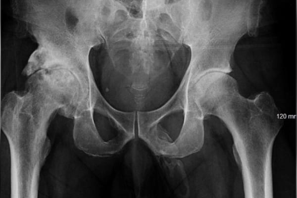 Hombre fue al doctor y descubrió que su pene se está convirtiendo en hueso
