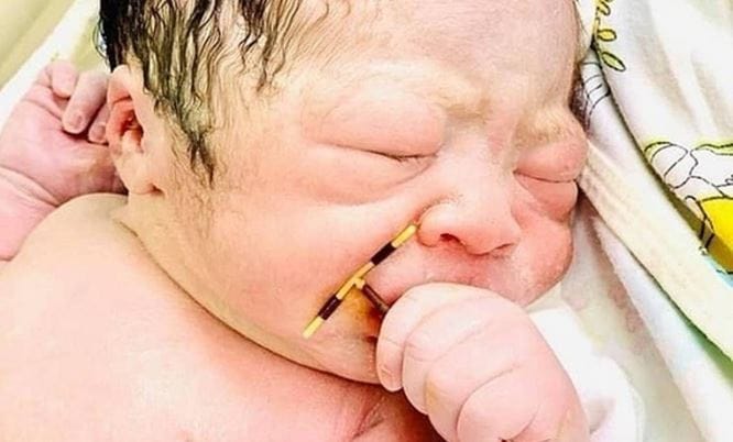 Viralizan foto de recién nacido con anticonceptivo DIU en la mano