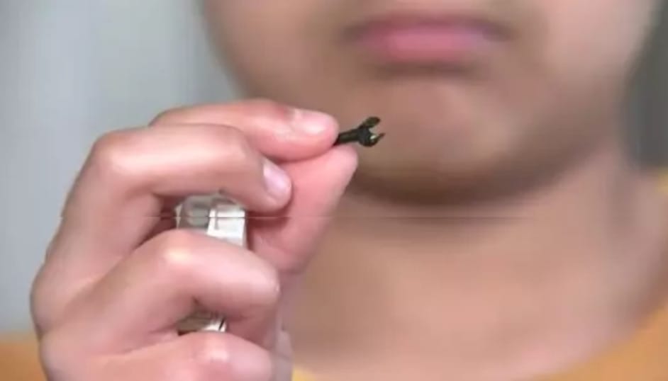 Niño encuentra pieza de Lego que estuvo atascada en su nariz durante dos años