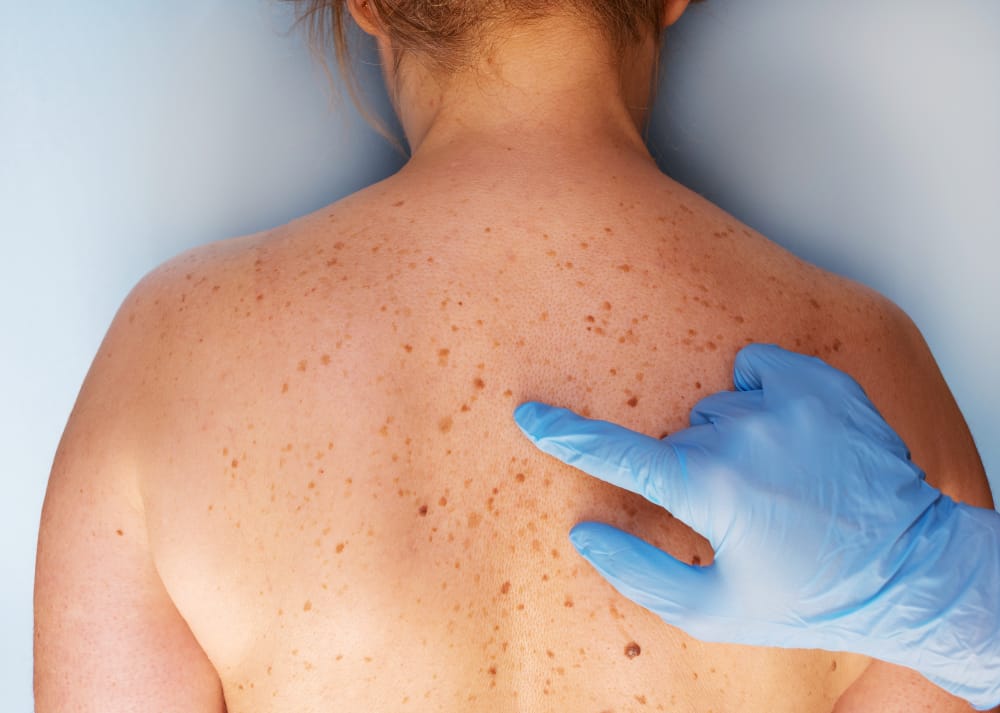 En Chile mueren más de 300 personas al año a causa del cáncer de piel