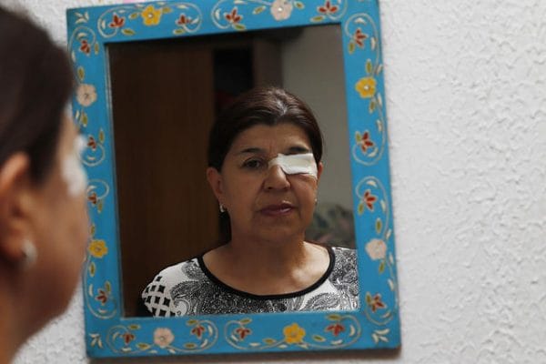 Mujer de Chillán que perdió ojo el 18-O recibió oferta gratuita de empresa alemana: Una prótesis ocular