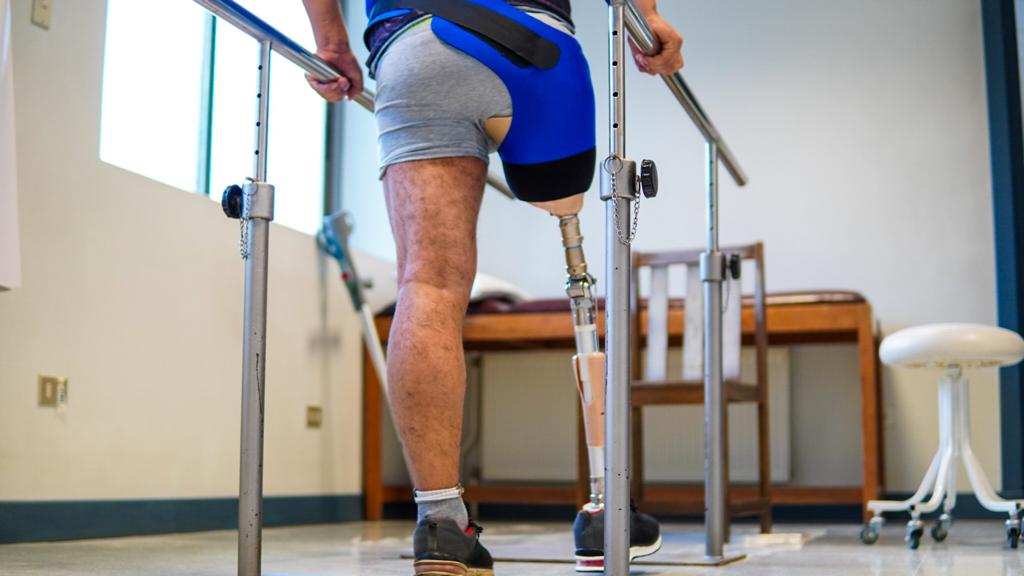 Más de 20 pacientes amputados en Biobío accederán a prótesis para extremidades inferiores