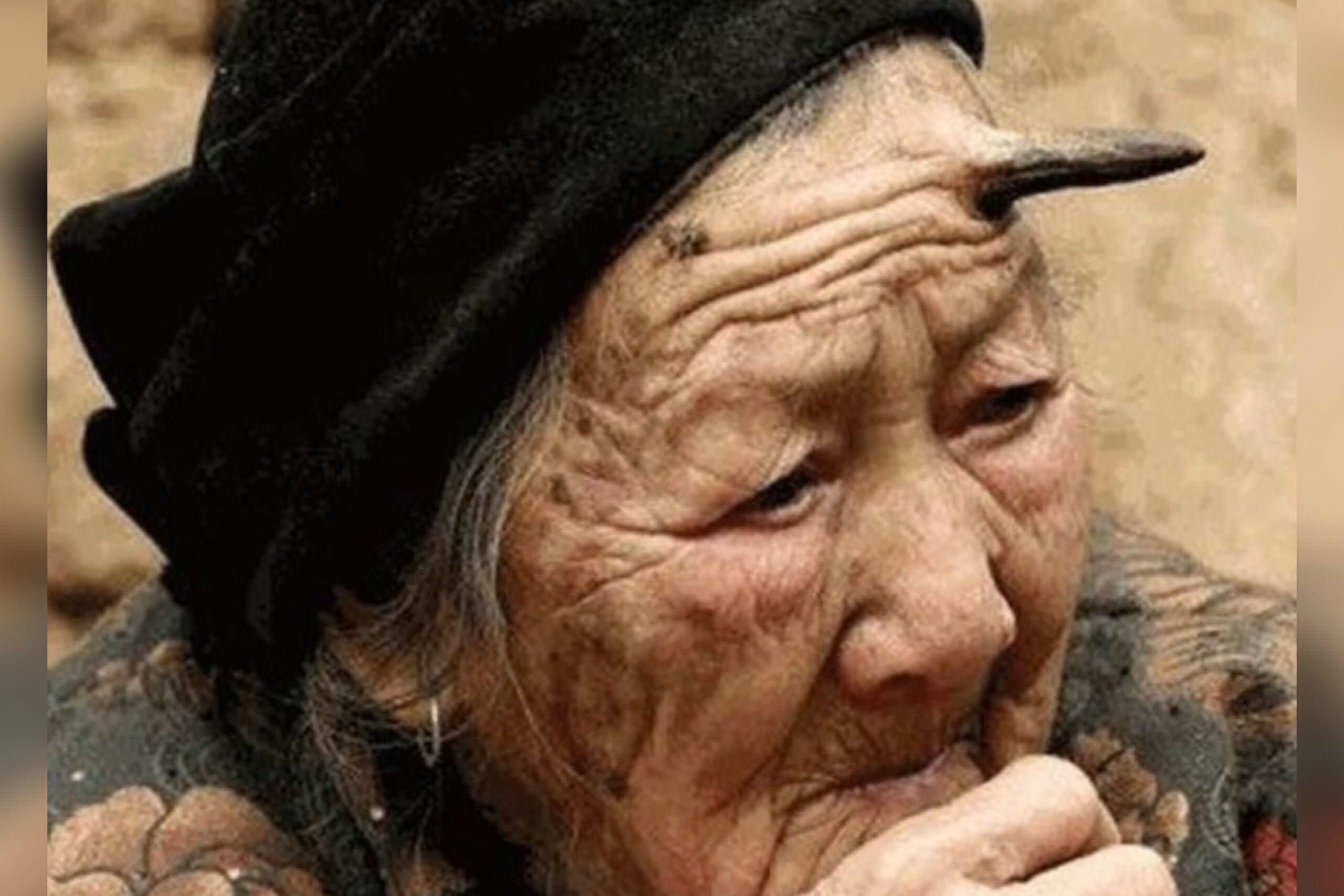 Mujer de 101 años tiene un cuerno en la frente de casi seis centímetros