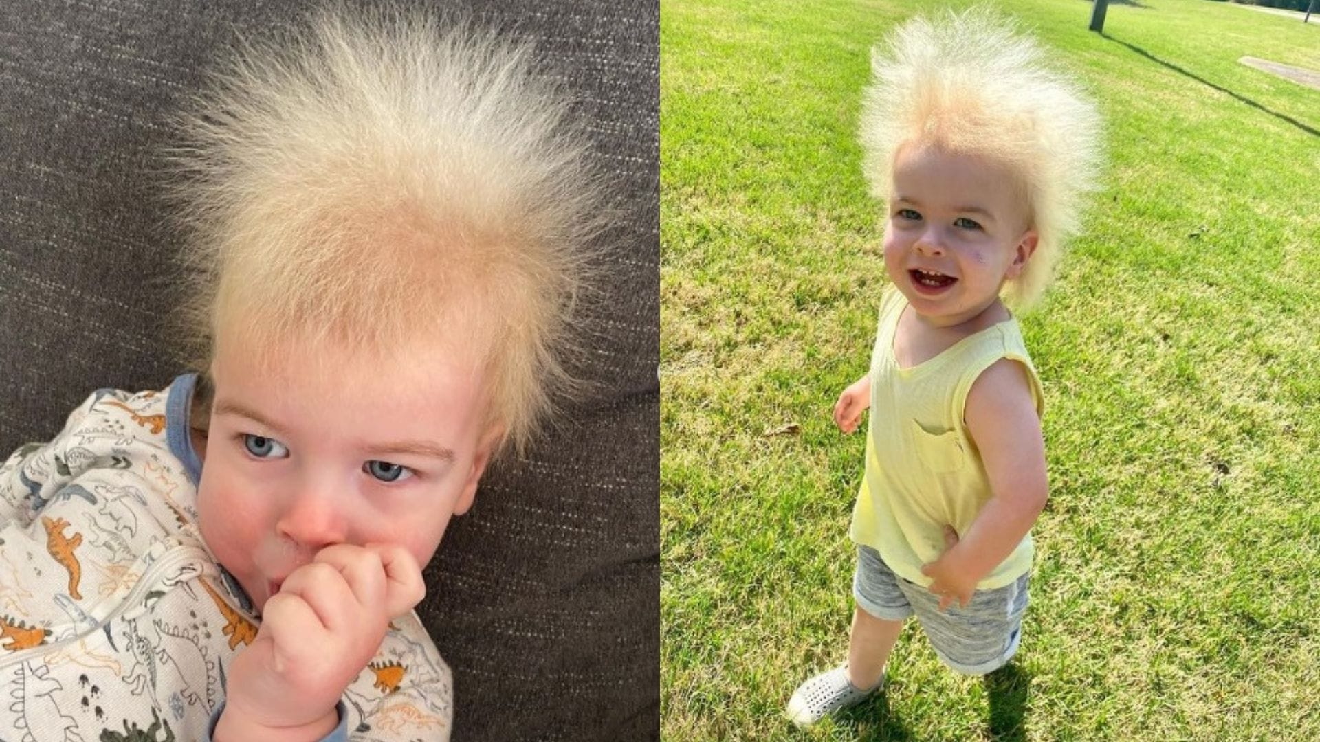 La historia de Locklan, el niño que padece del raro síndrome de cabello impeinable