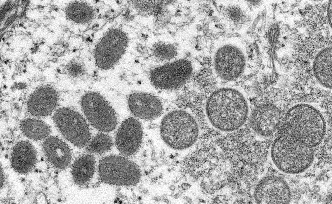 Confirman el primer caso de Viruela del Mono en Chile