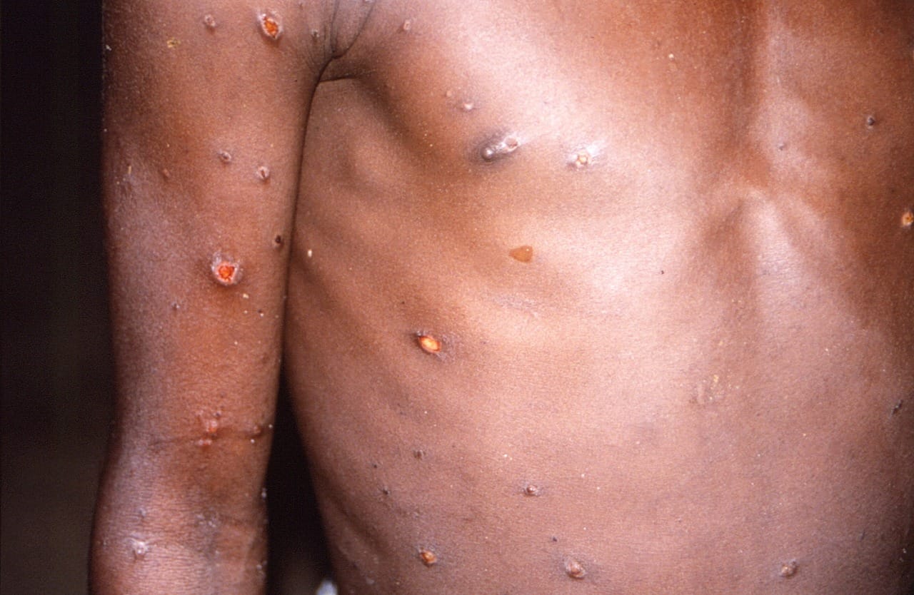 Reino Unido ofrece la vacuna contra la viruela del mono que se extiende por Europa