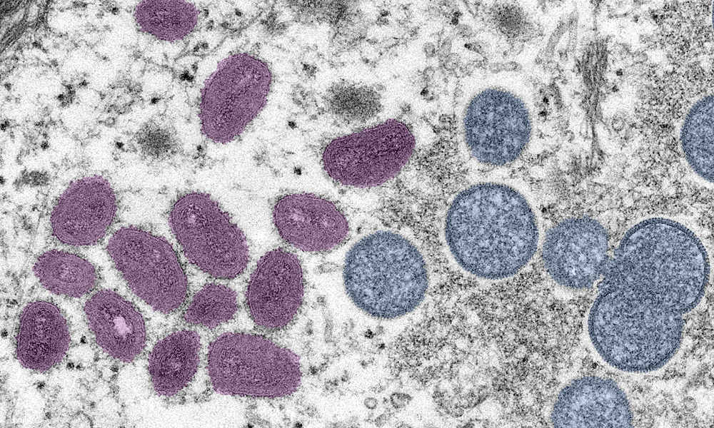 Detectan a la primera persona en contagiarse de VIH, Covid-19 y viruela del mono al mismo tiempo