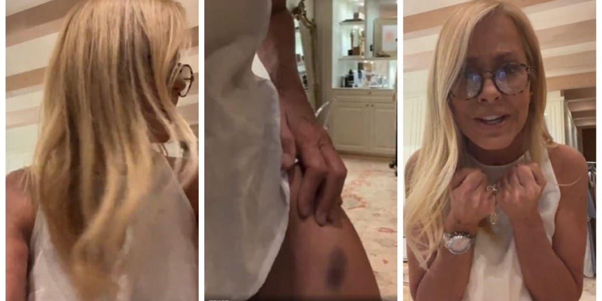 “Me saqué la recon…”: Cecilia Bolocco muestra las lesiones que sufrió tras accidente en su hogar