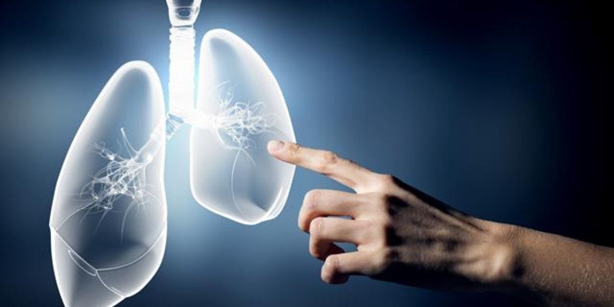 Los beneficios y ventajas de la inmunoterapia en pacientes con cáncer de pulmón