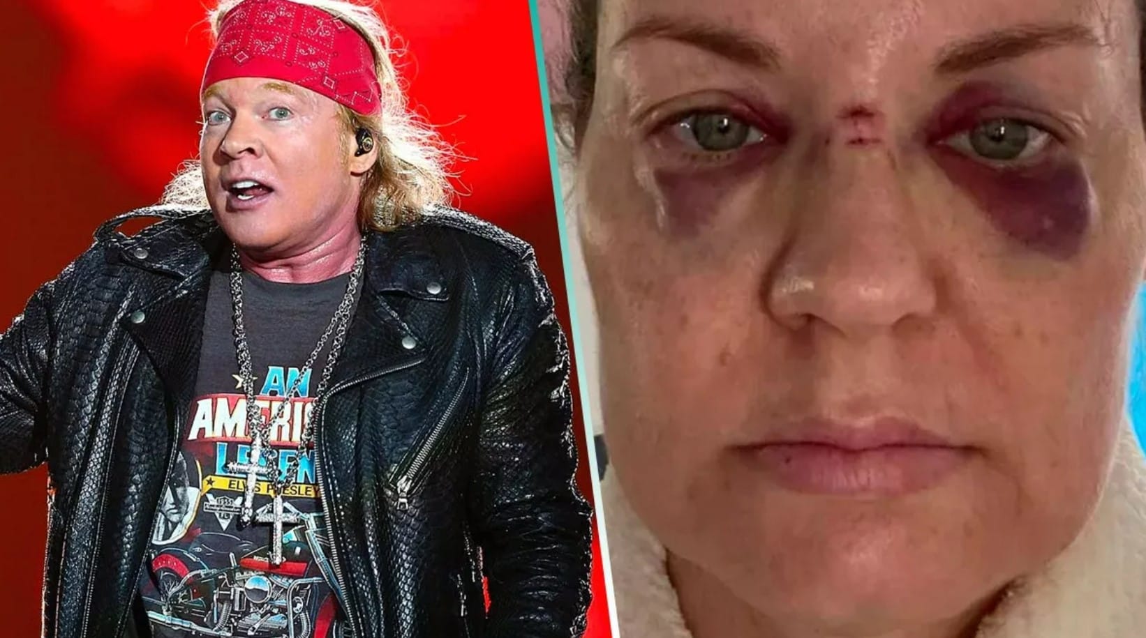 Quedó sangrando: Axl Rose dio feroz “microfonazo” a fan australiana de Guns N’ Roses