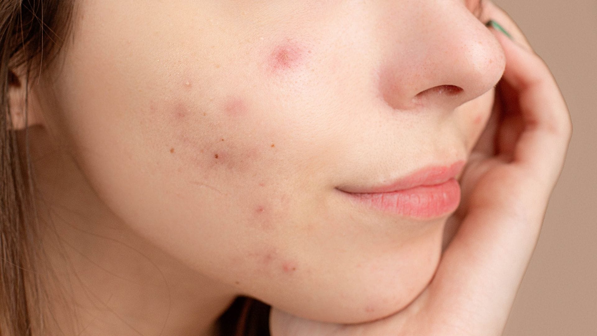 Anticonceptivos para el tratamiento del acné en las mujeres: ¿Cómo funcionan?