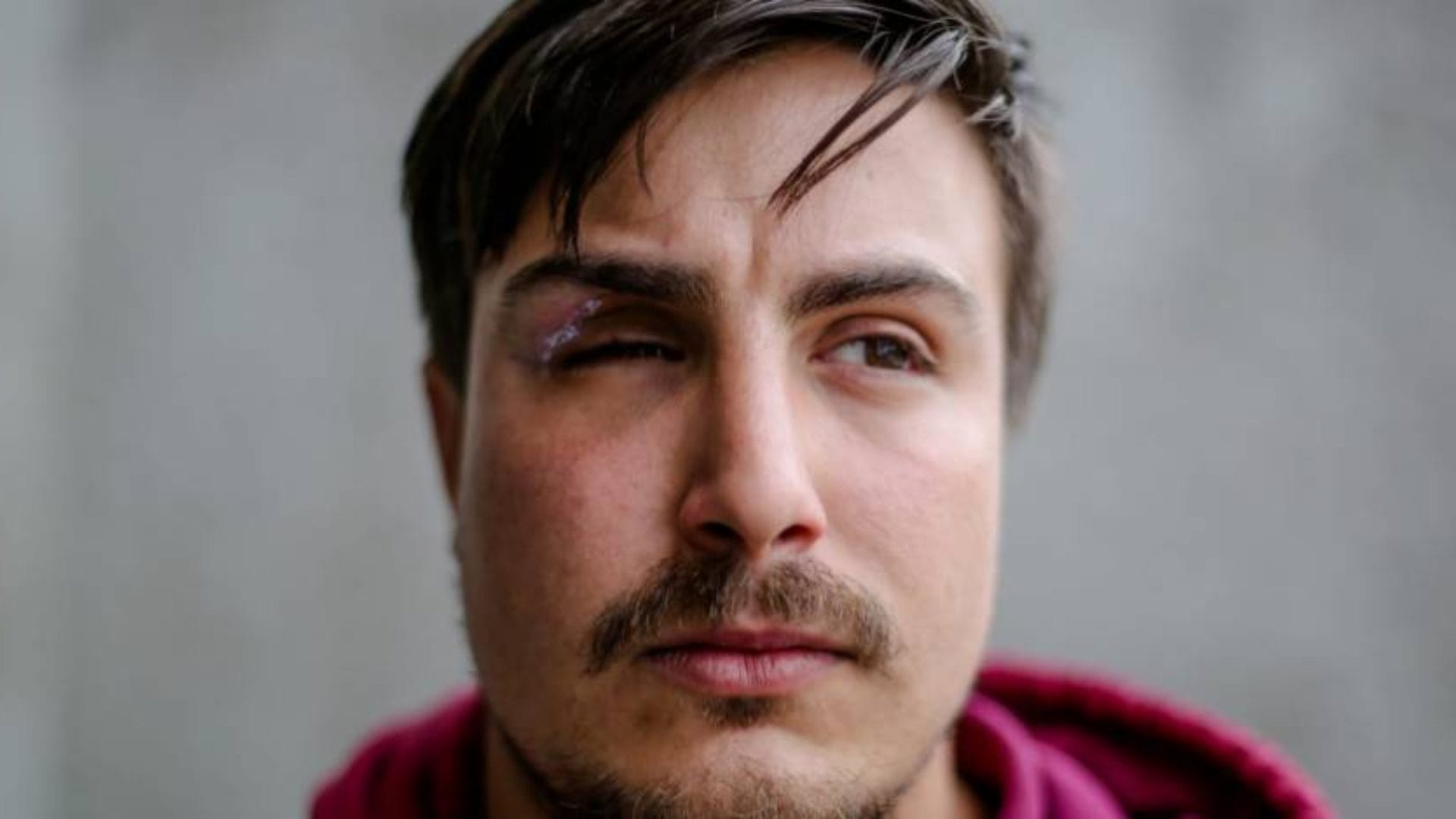 Rodrigo Lagarini, víctima de trauma ocular en Concepción, por discurso de Boric sobre Piñera: “Le baja el perfil a lo que pasó”