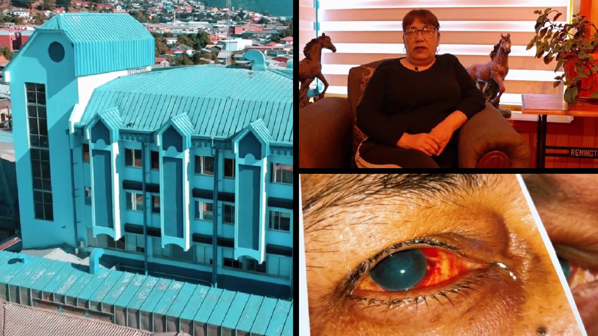 Mujer perdió visión en un ojo tras fallida cirugía en Tomé: Acusan presunta negligencia médica de oftalmólogo que aplicó químico incorrecto