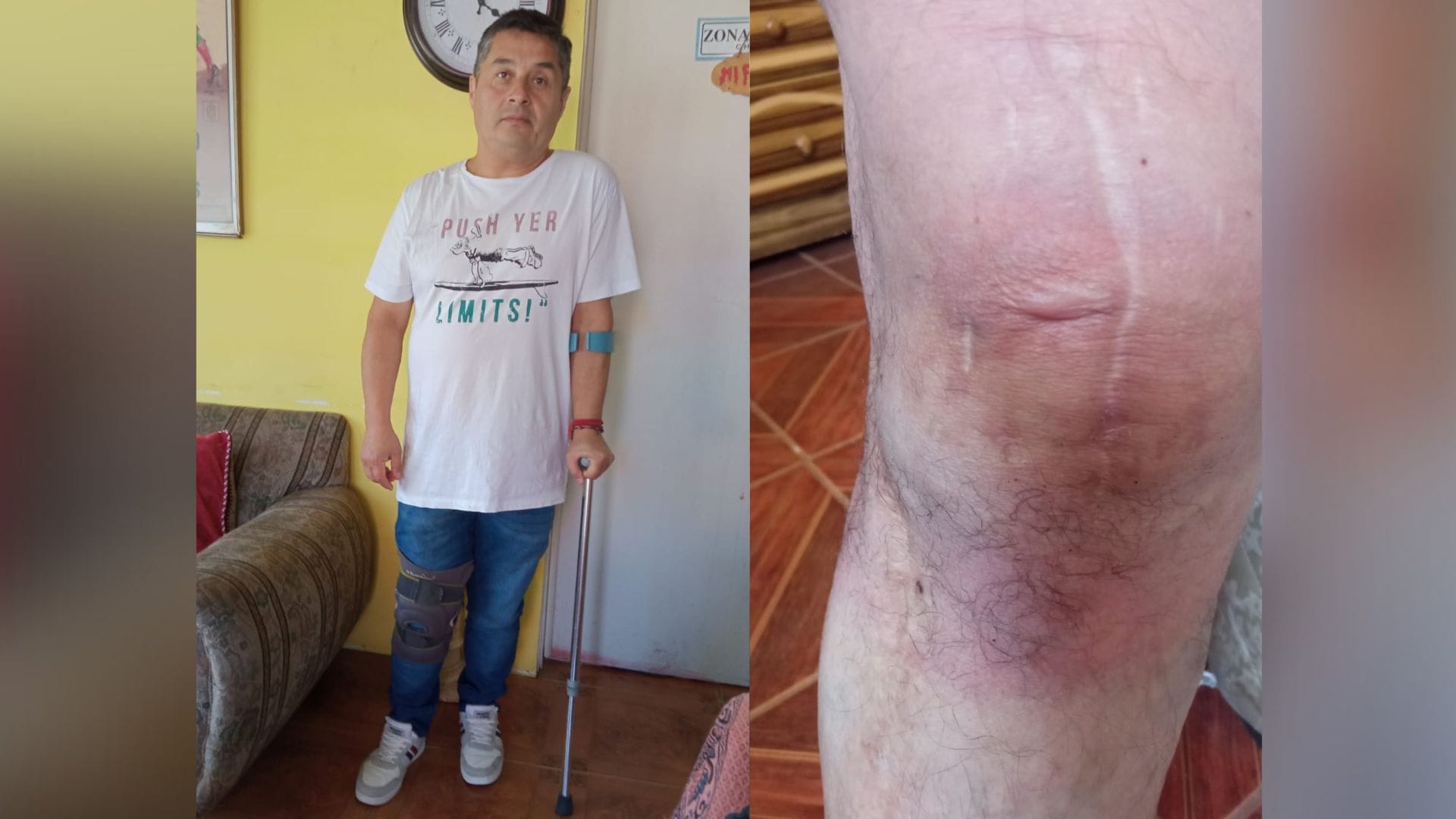 Recibió 13 intervenciones en su rodilla: Vecino de Chiguayante ve deteriorada su calidad de vida
