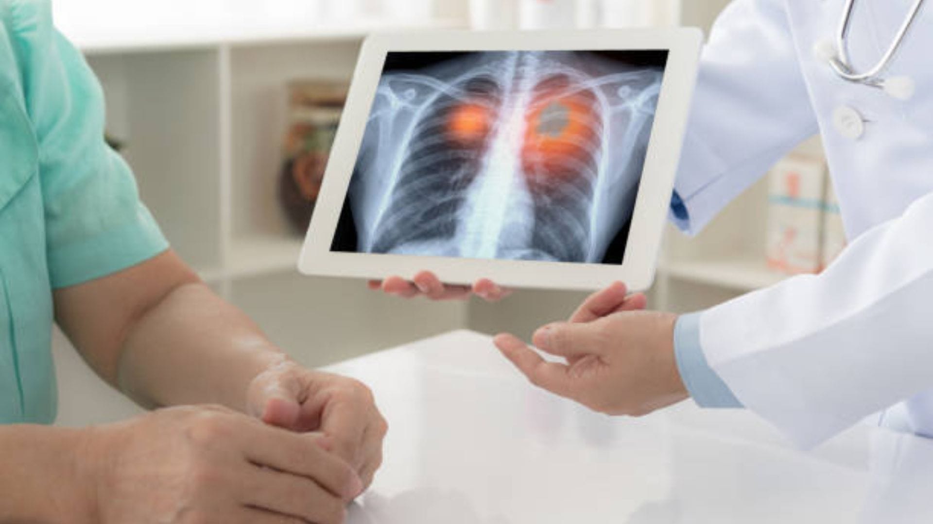 Preocupa alza en cifras de cáncer pulmonar en el Biobío: Mall del Centro Concepción contará con stand informativo para educar sobre prevención