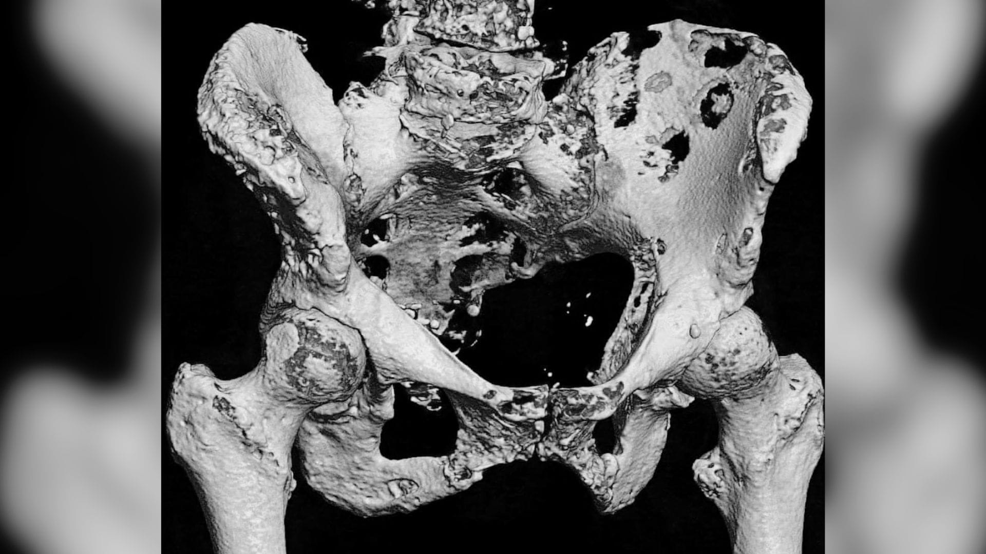 Metástasis en el cáncer de huesos: ¿Qué es y cómo tratarlo con inmunoterapia?