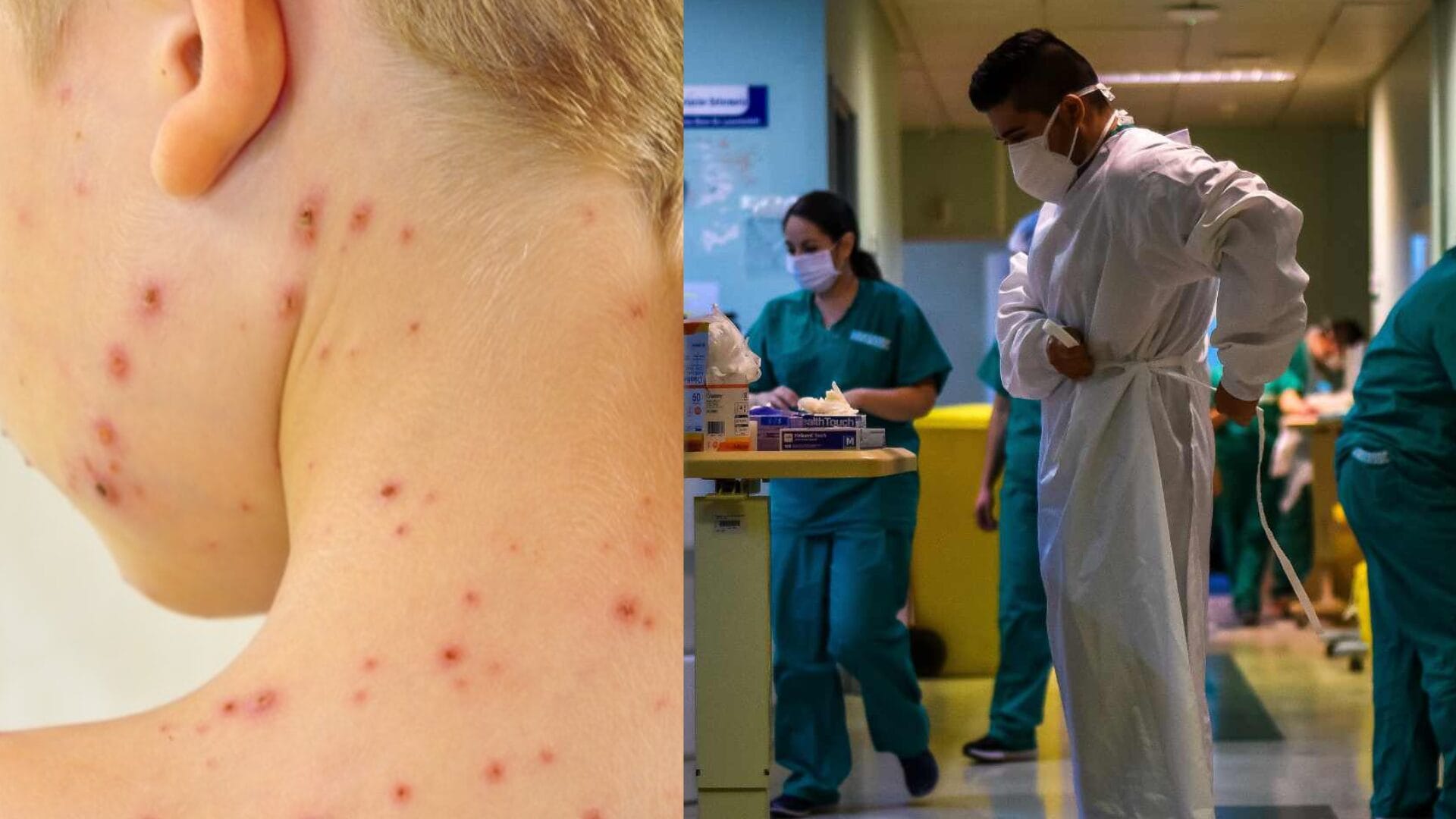 Alerta por “bacteria asesina”: Brote de estreptococo agrava casos de influenza en Chile