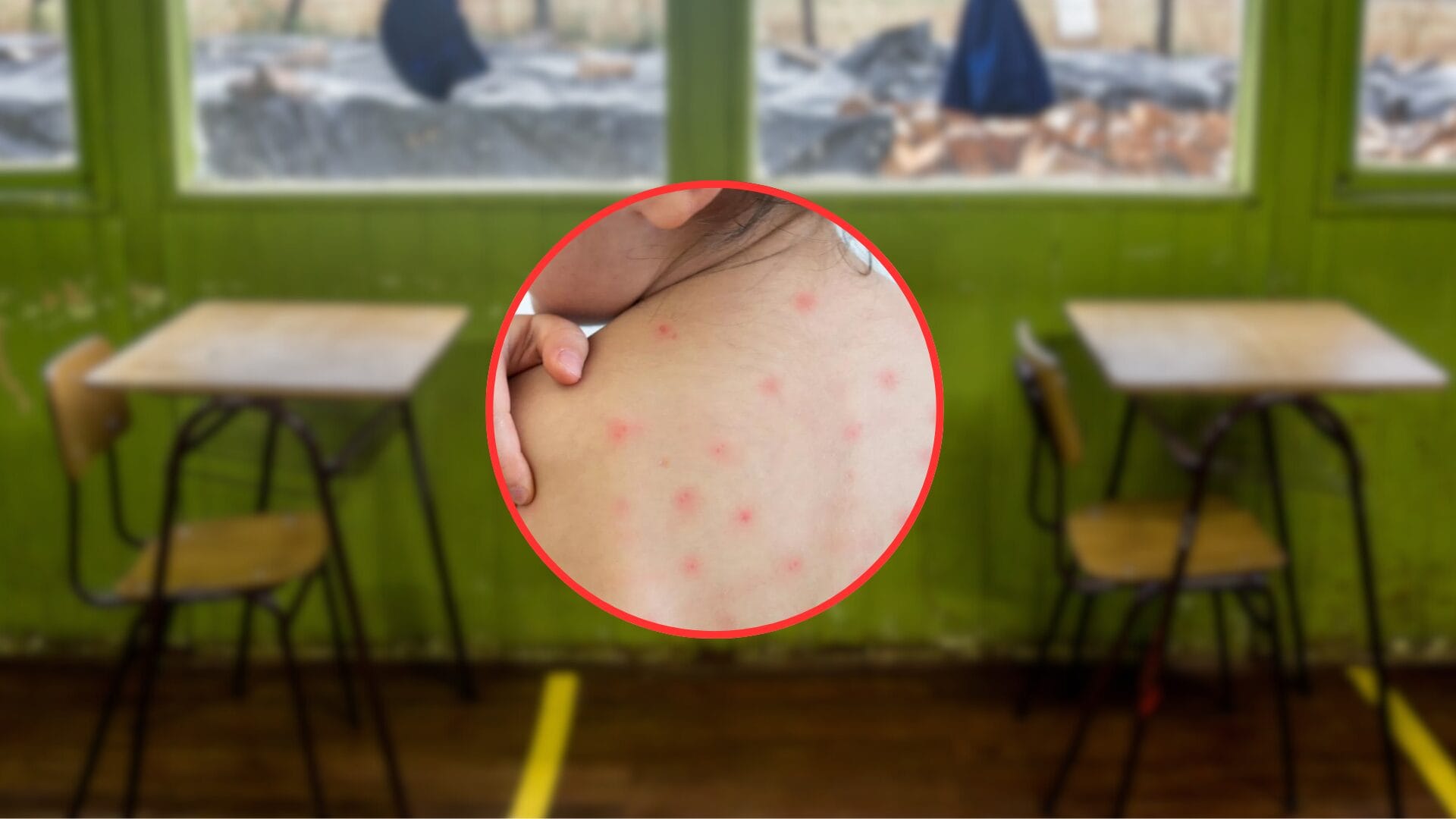 Detectan brote de varicela en escuela del Biobío que hospitalizó a dos menores
