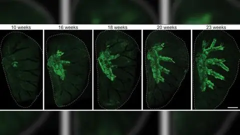 Espían a “células mutantes” que serían el origen del cáncer de pulmón en investigación que incluyó a científico chileno