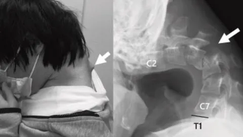 Síndrome de la cabeza caída: Joven japonés desarrolla grave deformación cervical por uso excesivo del celular