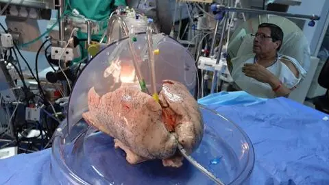 Como en Dr. House: El primer trasplante bipulmonar con tecnología ex vivo en Chile