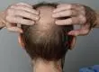 Podría causar depresión e ideación suicida: Advierten sobre medicamento para la alopecia