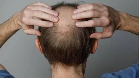 Podría causar depresión e ideación suicida: Advierten sobre medicamento para la alopecia