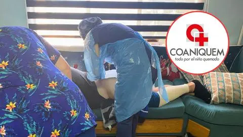 Coaniquem refuerza atención gratuita a personas quemadas tras incendios forestales en el Gran Concepción