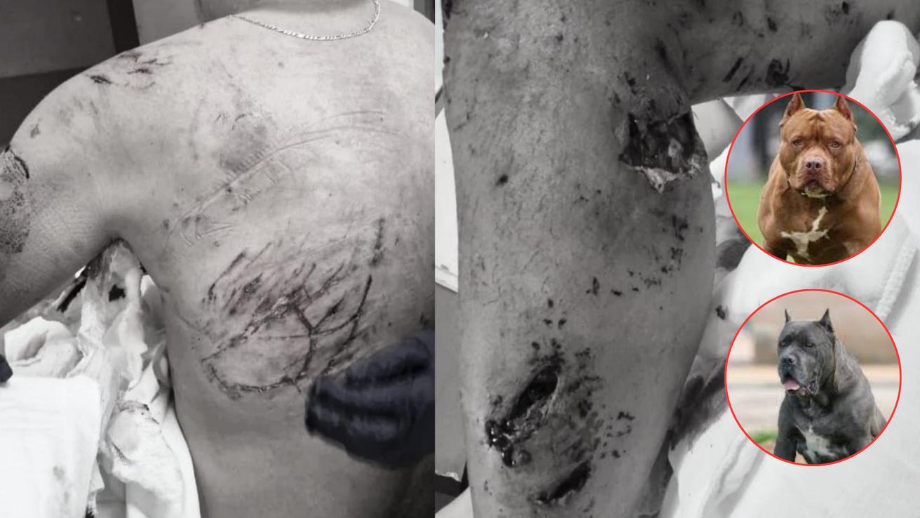 “Estuvo entre la vida y la muerte”: hombre sufre feroz ataque de jauría de perros en Hualqui