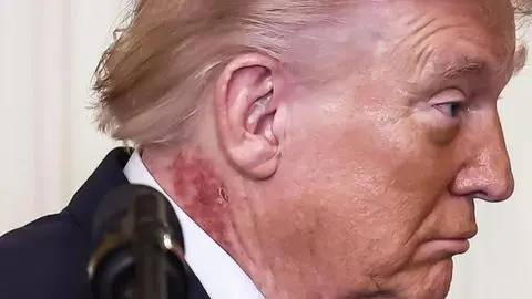 Extraña mancha roja ha aparecido en el cuello de Donald Trump: Su médico explicó estado de salud