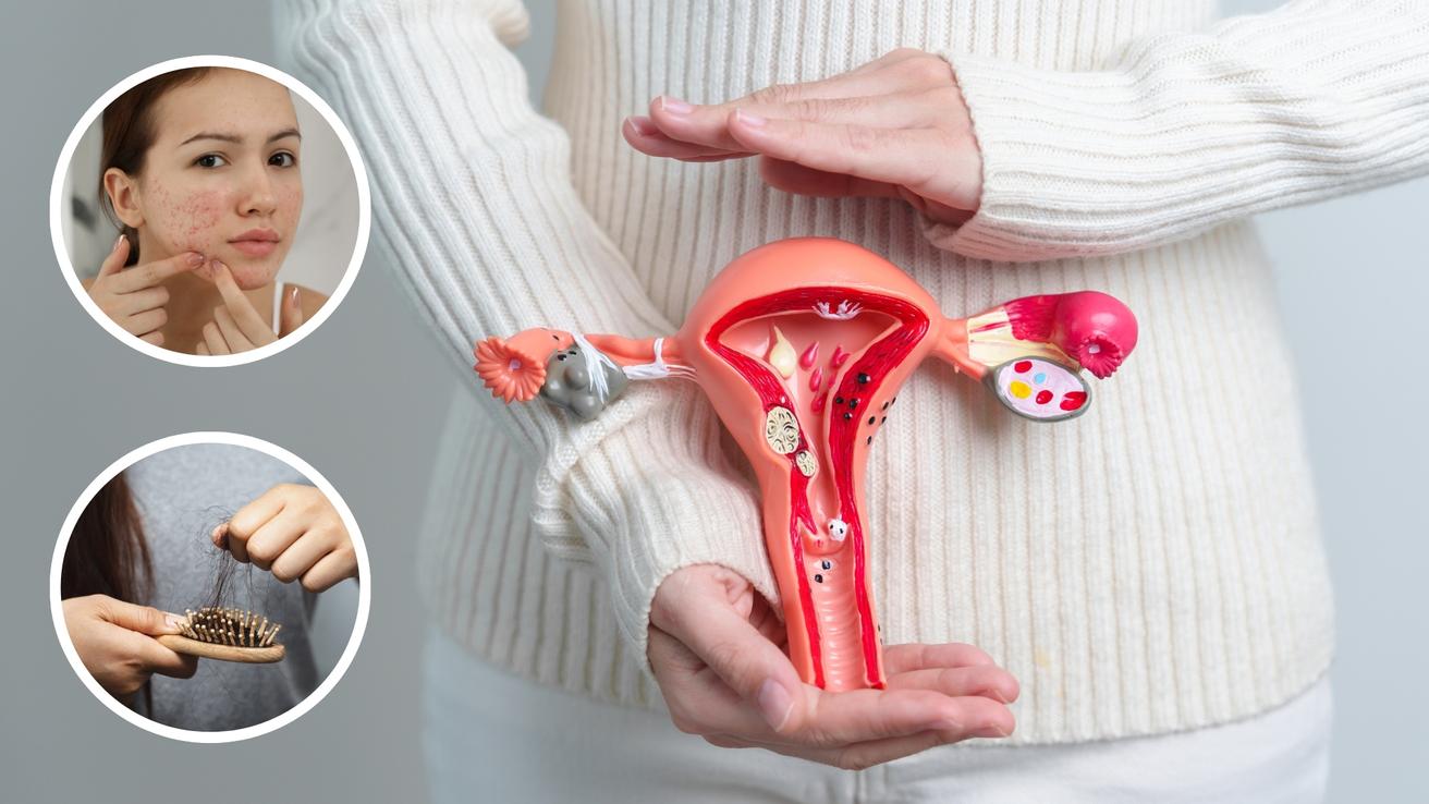 Expertos anuncian nuevo nombre para el Síndrome de Ovario Poliquístico