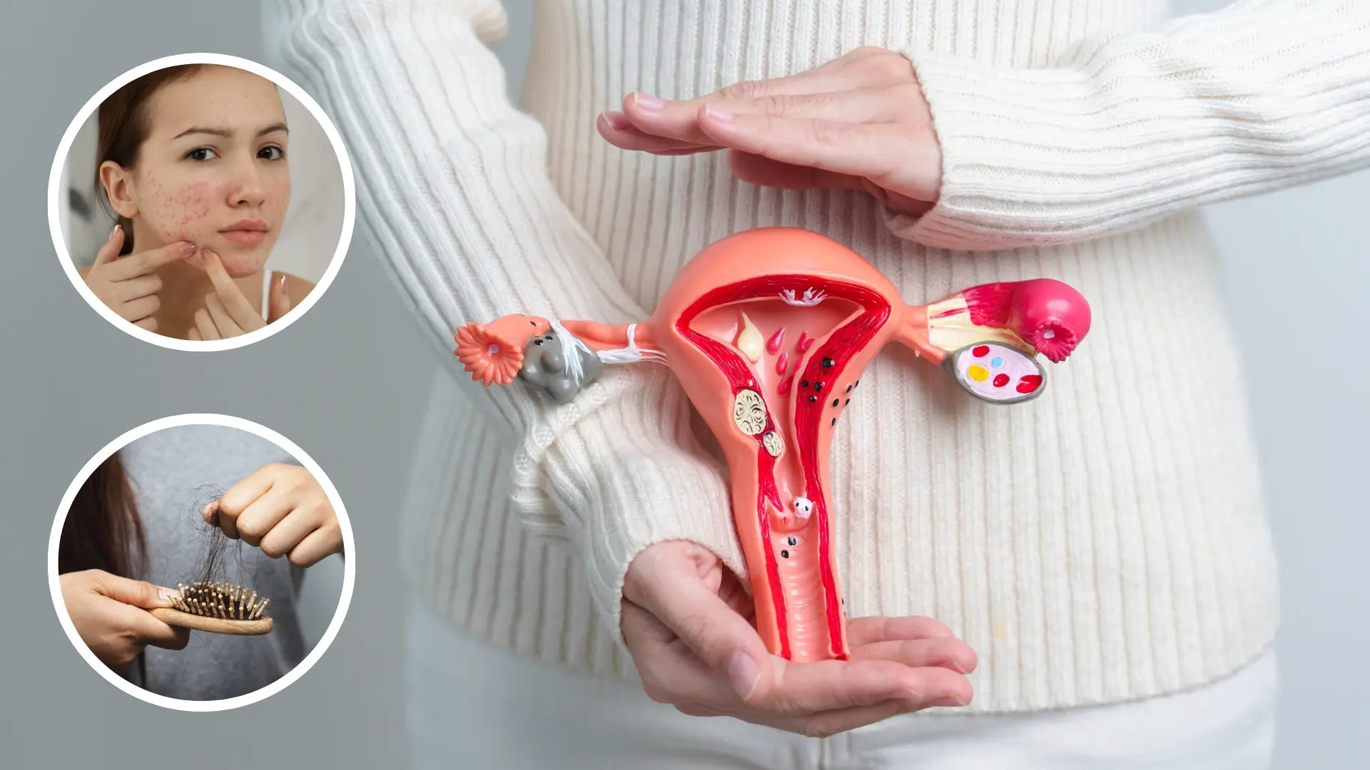 Expertos anuncian nuevo nombre para el Síndrome de Ovario Poliquístico