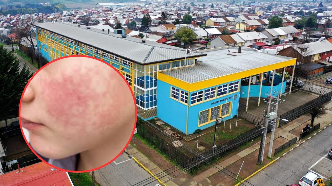 Enfermedad infecciosa se propaga por colegio de Victoria y afecta al menos a 15 niños